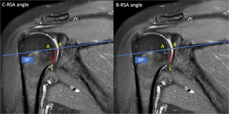 The Reverse Shoulder Arthroplasty Angle in MRI: Impact of the Articular Cartilage in the Estimated Inclination of the Inferior Glenoid.