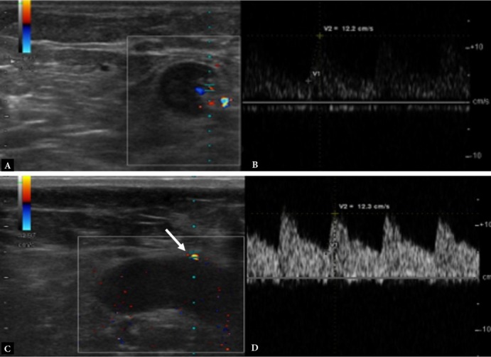 Diagnostic Efficacy of Ultrasonography, Doppler Ultrasonography and Elastography in the Evaluation of Suspected Malignant Lymph Nodes.