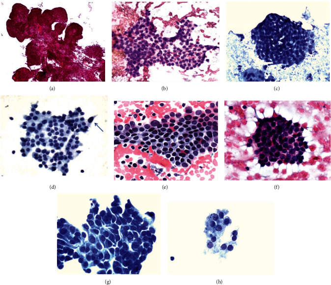 The Accurate Interpretation and Clinical Significance of Morphological Features of Fine Needle Aspiration Cells in Papillary Thyroid Carcinoma.