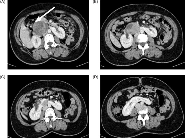 Renal Cell Carcinoma Arising from Isthmus of Horseshoe K.