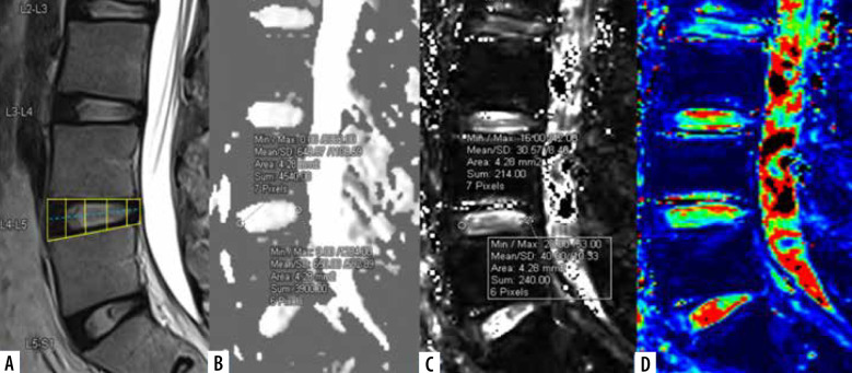 Apparent diffusion coefficient and T2* mapping on 3T MRI in normal and degenerative lumbar intervertebral discs.