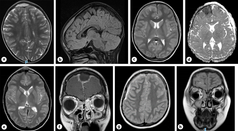 Intracranial Empyemas in the COVID-19 Era: A New Phenomenon? A Paediatric Case Series and Review of the Literature.