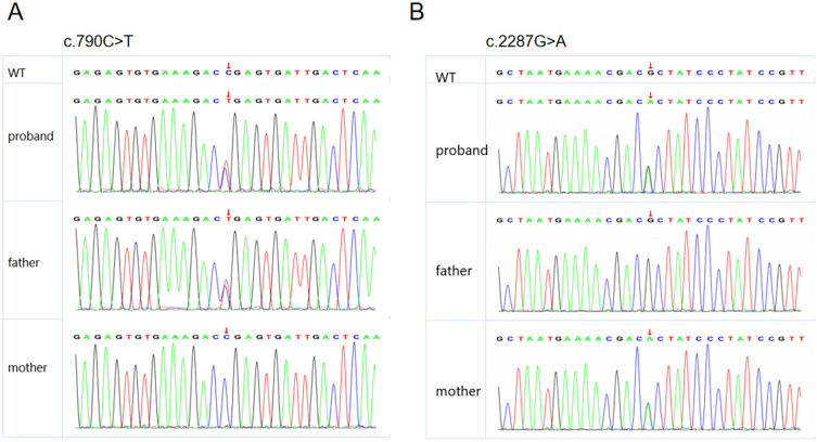 Case Report: Congenital Myasthenic Syndrome Presenting with Bilateral Vocal Cord Paralysis Caused by De-Novel Compound Heterozygous MUSK Mutation.