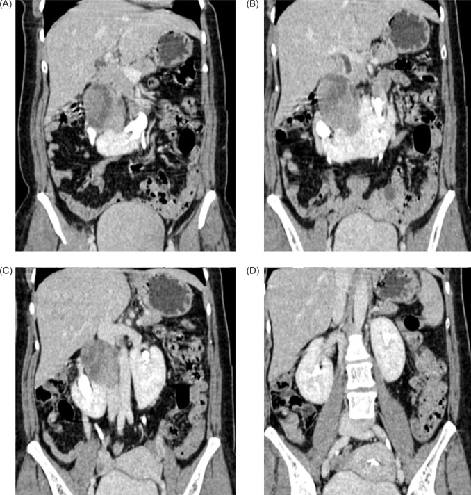 Renal Cell Carcinoma Arising from Isthmus of Horseshoe K.