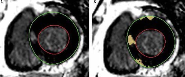 The association of left atrial mechanics with left ventricular morphology in patients with hypertrophic cardiomyopathy: a cardiac magnetic resonance study.