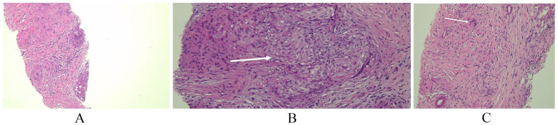 Sarcoidosis Mimicking a Malignant Metastatic Disease.