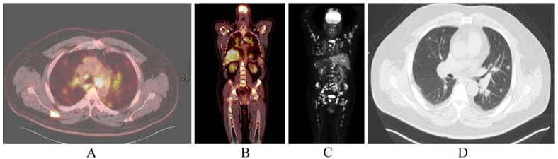 Sarcoidosis Mimicking a Malignant Metastatic Disease.