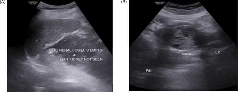 Renal Cell Carcinoma Arising from Isthmus of Horseshoe K.