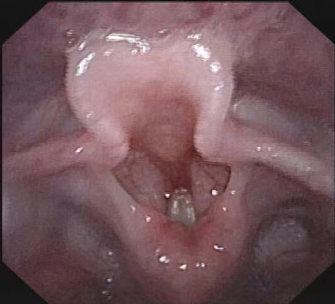 Case Report: Congenital Myasthenic Syndrome Presenting with Bilateral Vocal Cord Paralysis Caused by De-Novel Compound Heterozygous MUSK Mutation.