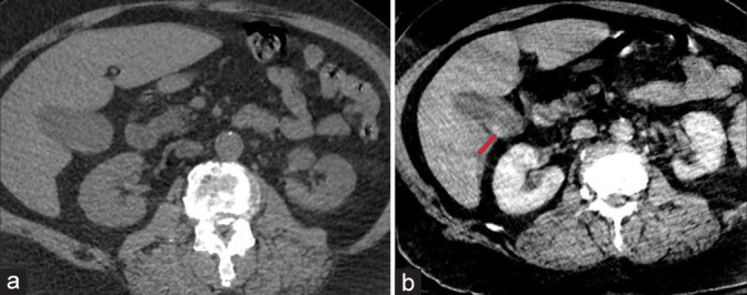 Quality assurance for non-contrast CT of the abdomen and pelvis during a period of supply chain disruption leading to iodinated contrast shortage in the emergency department setting.