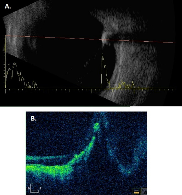 Pseudomelanoma: occult intraocular foreign body mimicking choroidal melanoma.