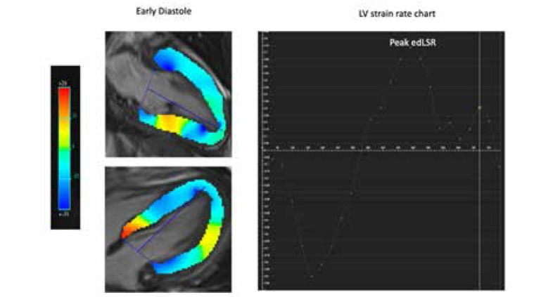 The association of left atrial mechanics with left ventricular morphology in patients with hypertrophic cardiomyopathy: a cardiac magnetic resonance study.