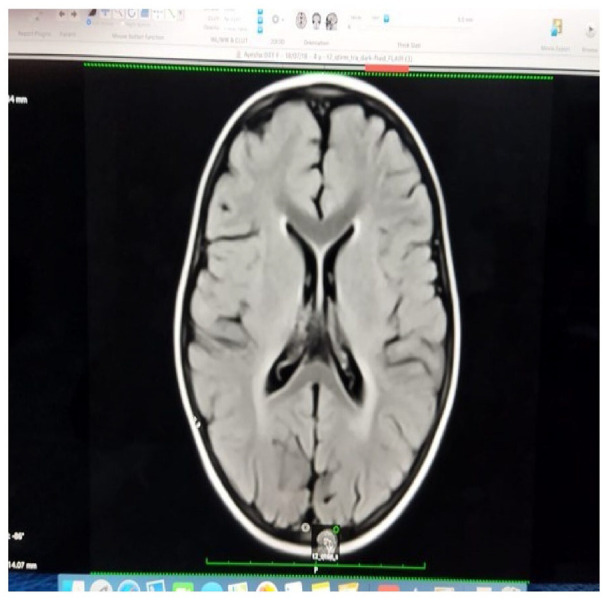 Pelizaeus-Merzbacher Disease in a 4-Year-Old Female Child: "A Rare Case Report".