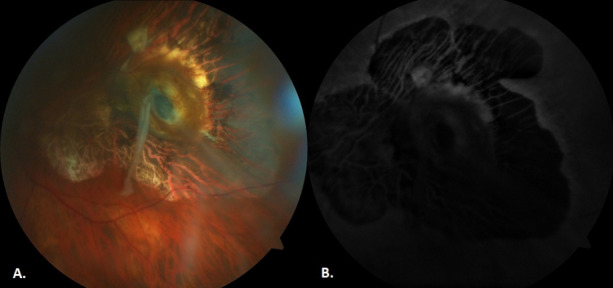 Pseudomelanoma: occult intraocular foreign body mimicking choroidal melanoma.