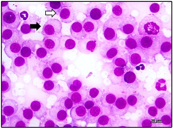 Fibrosis in canine transmissible venereal tumor after chemotherapy with vincristine.