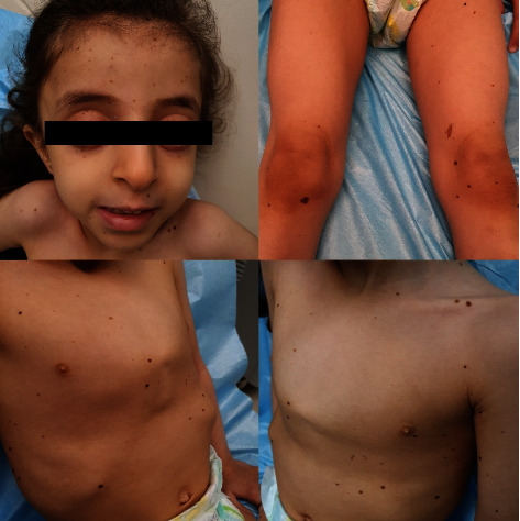 LEOPARD Syndrome with a Sporadic <i>PTPN11</i> Mutation in a Saudi Patient.