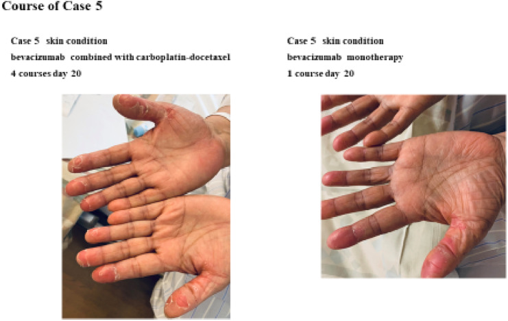 Five cases of skin desquamation due to bevacizumab combined with docetaxel-carboplatin in ovarian cancer.