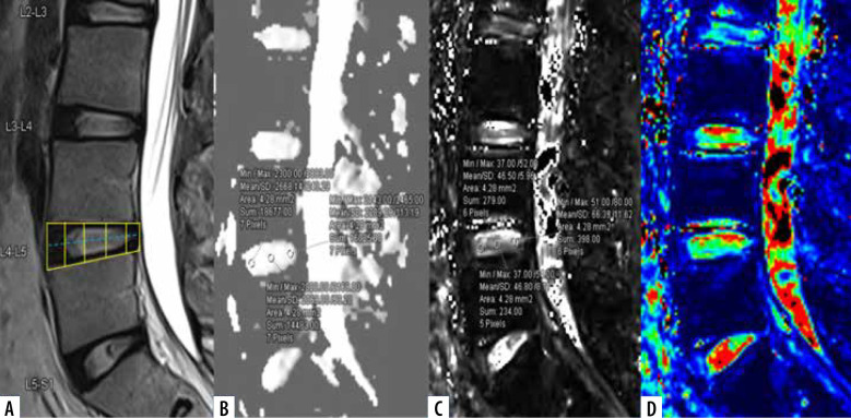 Apparent diffusion coefficient and T2* mapping on 3T MRI in normal and degenerative lumbar intervertebral discs.