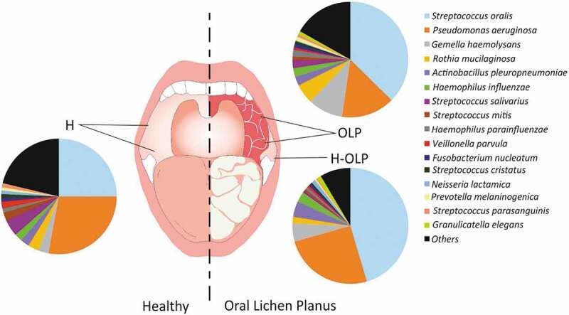 Metataxonomic and metaproteomic profiling of the oral microbiome in oral lichen planus - a pilot study.