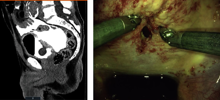 Robot-Assisted Repair of Bladder Rupture following Penile Ring Entrapment.