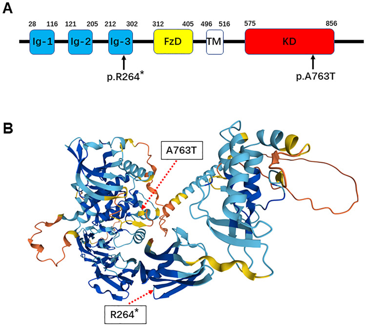 Case Report: Congenital Myasthenic Syndrome Presenting with Bilateral Vocal Cord Paralysis Caused by De-Novel Compound Heterozygous MUSK Mutation.