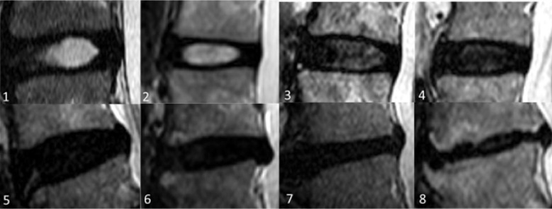 Apparent diffusion coefficient and T2* mapping on 3T MRI in normal and degenerative lumbar intervertebral discs.