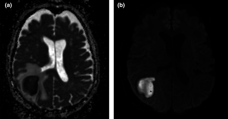<i>Actinomyces israelii</i> and <i>Fusobacterium nucleatum</i> brain abscess in an immunocompetent patient: case report.