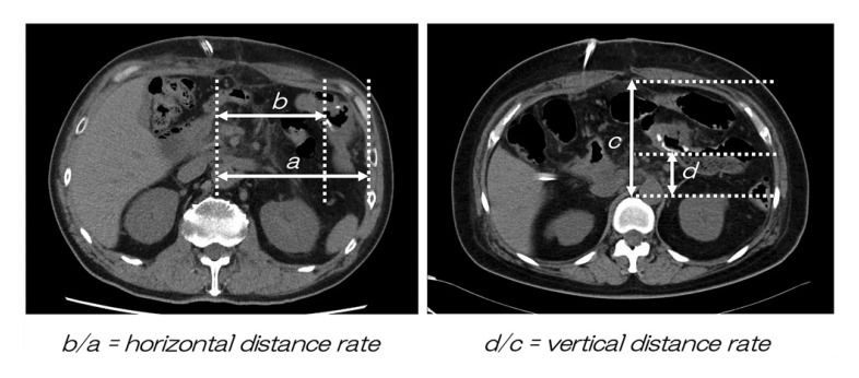 Effect of the Gastrojejunostomy Position on the Postoperative Amount of Oral Intake in Pancreaticoduodenectomy.