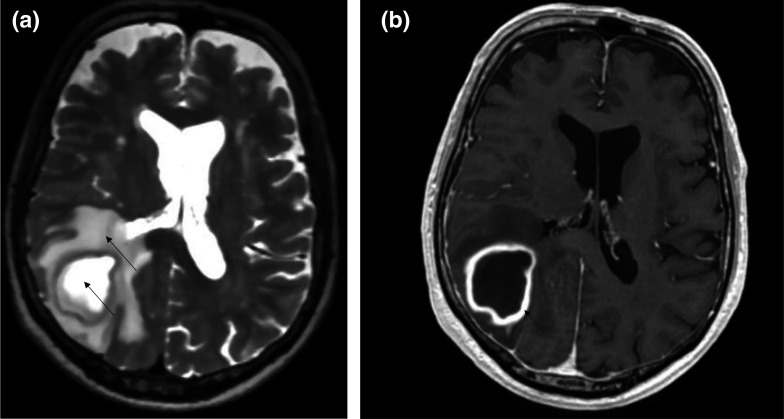 <i>Actinomyces israelii</i> and <i>Fusobacterium nucleatum</i> brain abscess in an immunocompetent patient: case report.
