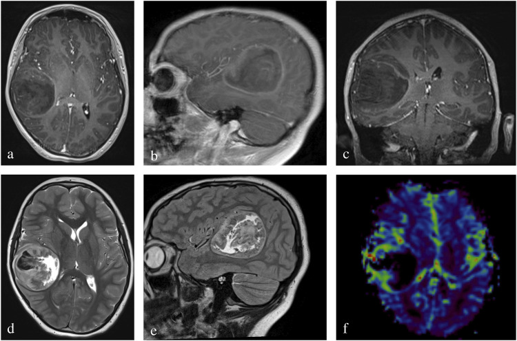 Pediatric diffuse hemispheric glioma H3 G34-mutant with gains of the BRAF locus: An illustrative case.