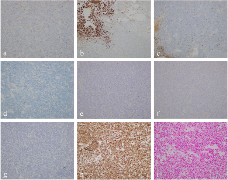 Pediatric diffuse hemispheric glioma H3 G34-mutant with gains of the BRAF locus: An illustrative case.