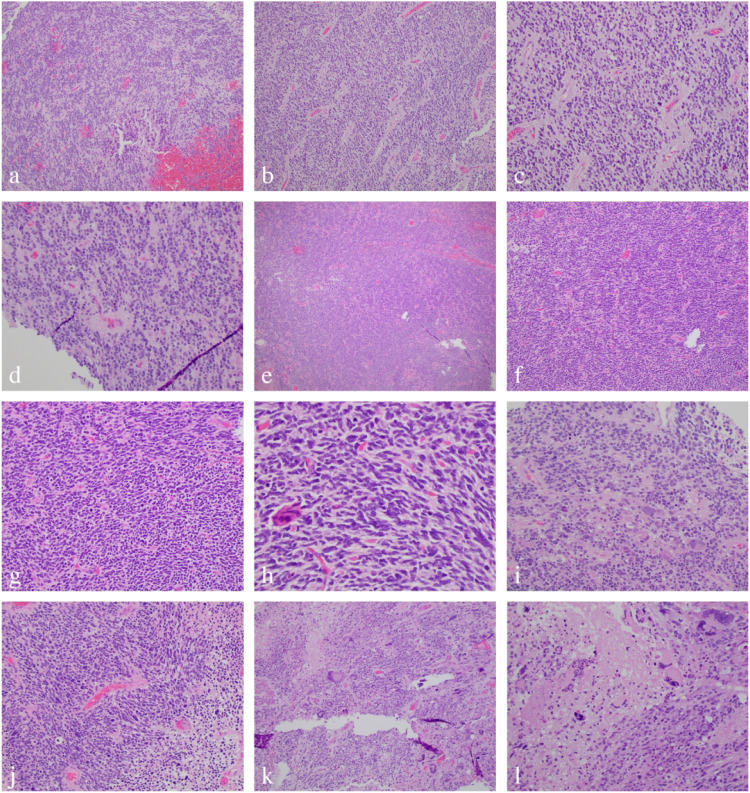 Pediatric diffuse hemispheric glioma H3 G34-mutant with gains of the BRAF locus: An illustrative case.