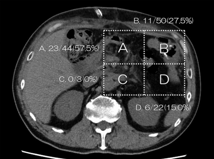 Effect of the Gastrojejunostomy Position on the Postoperative Amount of Oral Intake in Pancreaticoduodenectomy.