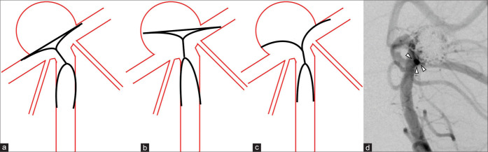 Usefulness of Y-shaped PulseRider-assisted coil embolization for basilar artery tip aneurysm with a misaligned axis: A case report.