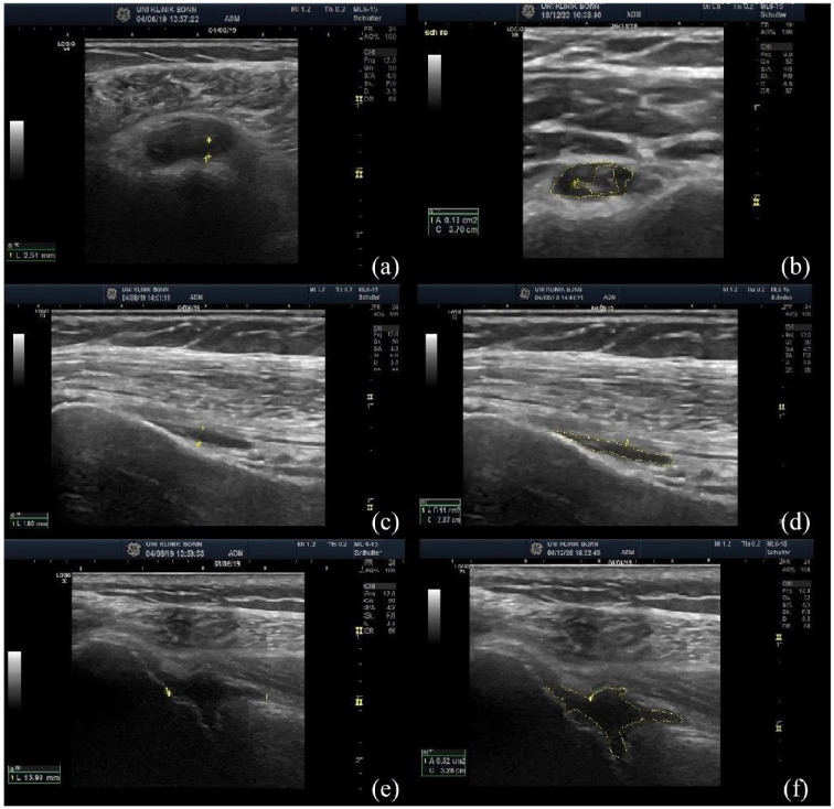 Prevalence and characteristics of giant cell arteritis in patients with newly diagnosed polymyalgia rheumatica - a prospective cohort study.