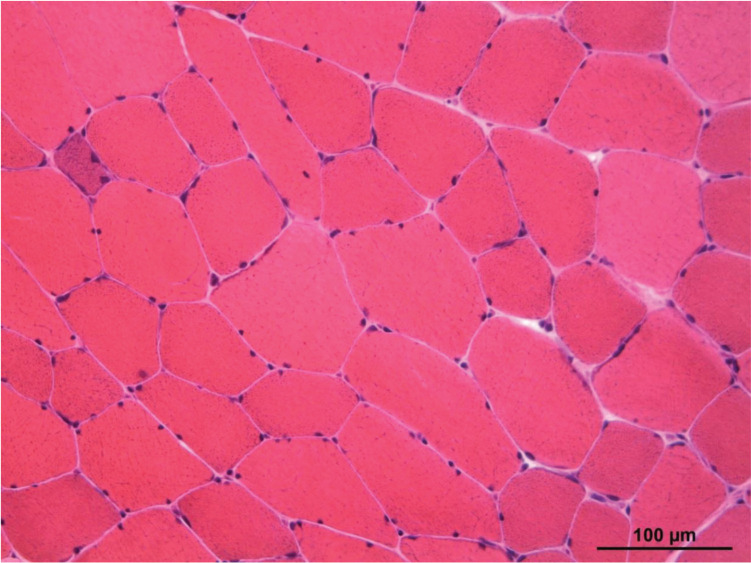 From recurrent rhabdomyolysis in a young adult to carnitine palmitoyltransferase II deficiency.