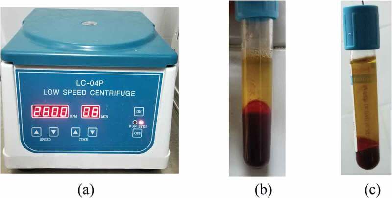 Platelet-rich plasma in patients affected with Peyronie's disease.