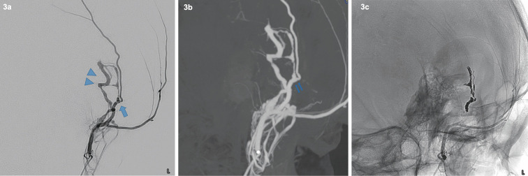 Spontaneous Middle Meningeal Arteriovenous Fistula Caused by Aneurysm Rupture: A Case Report.