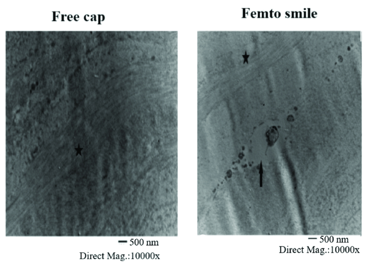 Histopathology of Corneal Lenticules Obtained from Small Incision Lenticule Extraction (SMILE) versus Microkeratome Excision.