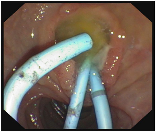 Unconventional treatment of inoperable biliary IPMN with an oesophageal stent in the common bile duct: case report.