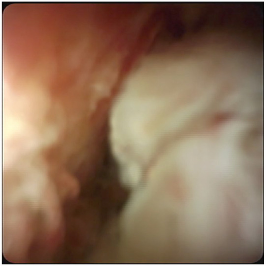 Unconventional treatment of inoperable biliary IPMN with an oesophageal stent in the common bile duct: case report.