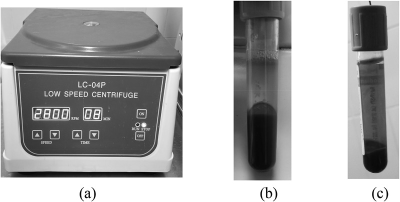 Platelet-rich plasma in patients affected with Peyronie's disease.