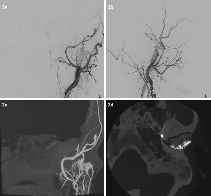 Spontaneous Middle Meningeal Arteriovenous Fistula Caused by Aneurysm Rupture: A Case Report.