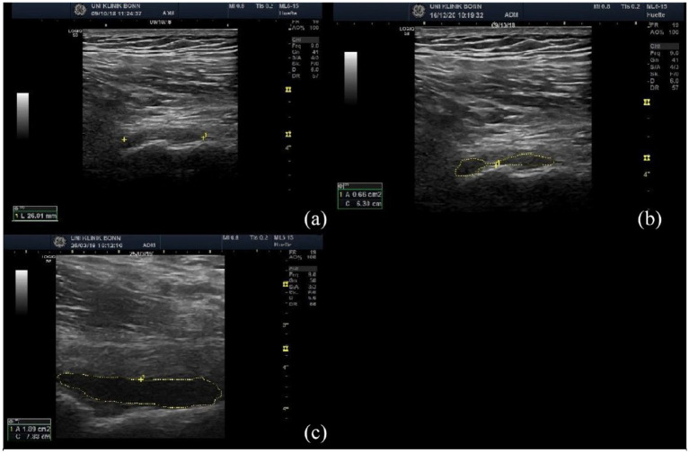 Prevalence and characteristics of giant cell arteritis in patients with newly diagnosed polymyalgia rheumatica - a prospective cohort study.