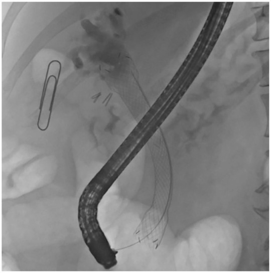 Unconventional treatment of inoperable biliary IPMN with an oesophageal stent in the common bile duct: case report.