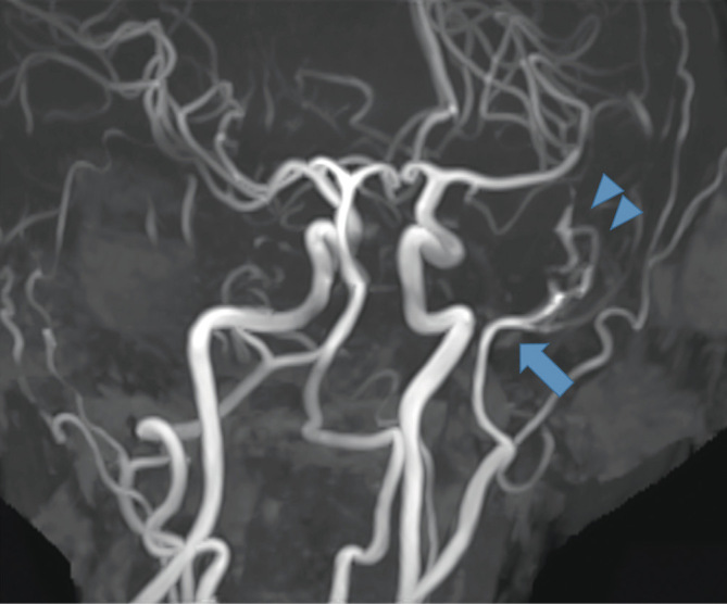 Spontaneous Middle Meningeal Arteriovenous Fistula Caused by Aneurysm Rupture: A Case Report.