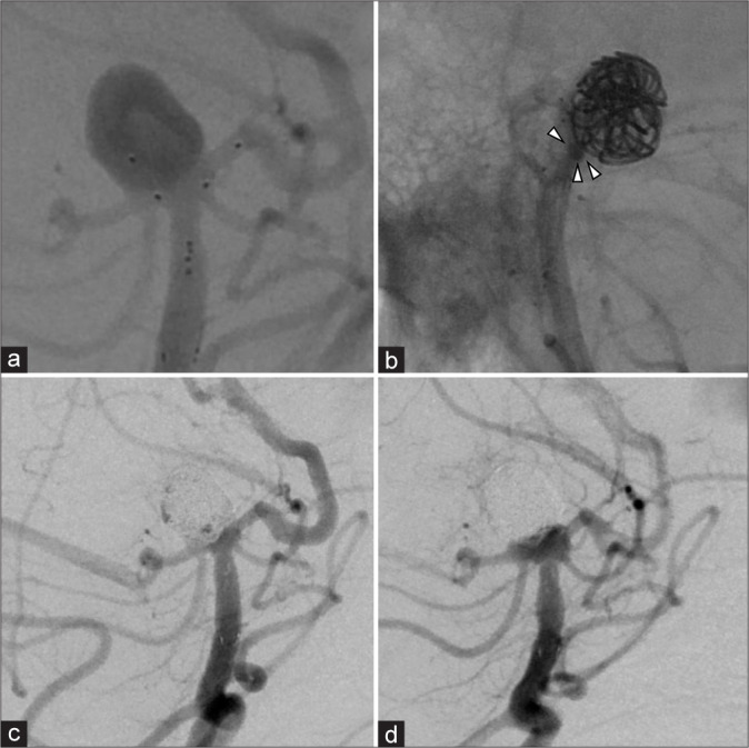 Usefulness of Y-shaped PulseRider-assisted coil embolization for basilar artery tip aneurysm with a misaligned axis: A case report.