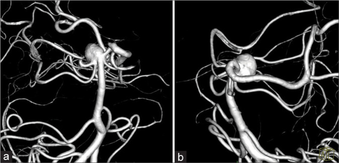 Usefulness of Y-shaped PulseRider-assisted coil embolization for basilar artery tip aneurysm with a misaligned axis: A case report.