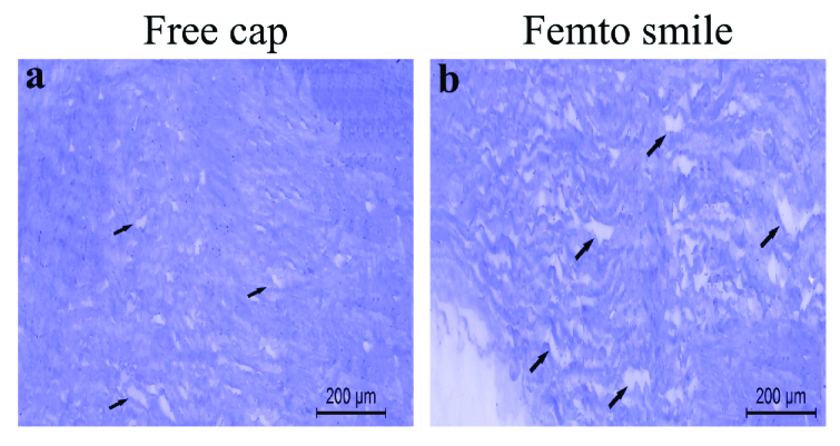 Histopathology of Corneal Lenticules Obtained from Small Incision Lenticule Extraction (SMILE) versus Microkeratome Excision.