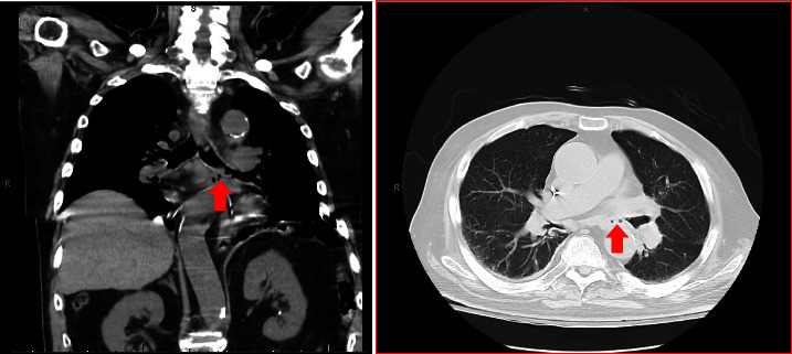 A Case of Esophago-Respiratory Fistula due to Inhalation Smoke Injury Diagnosed by Upper Endoscopy.